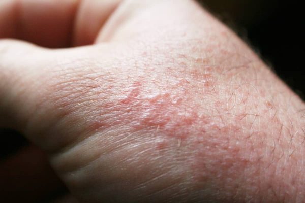 causes skin rashes that itch