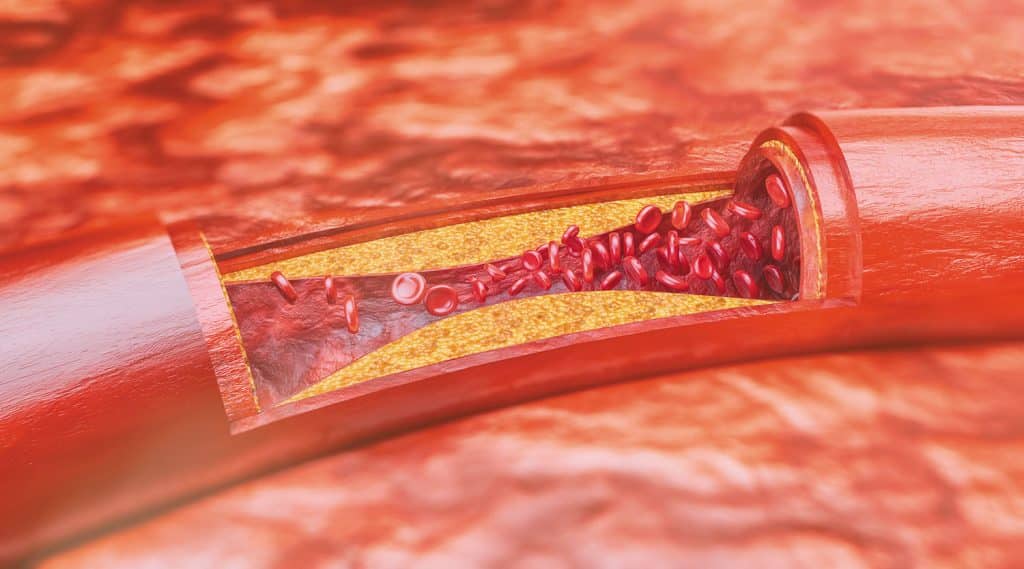 Kenali Lebih Dalam tentang Bahaya Gangguan Arteri Koroner