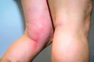 Reseller Kutus Kutus Palembang yang Membantu Anda Cegah Penyumbatan Darah